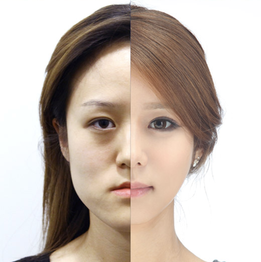 Corrective Jaw Surgery (Orthognathic)