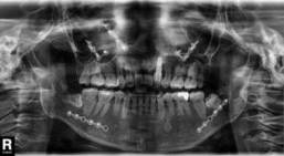 dental-mplant-for-missing-tooth-in-cleft-02