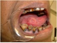 TongueMass